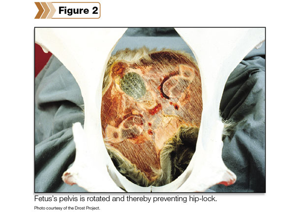 fetus's pelvis is rotated