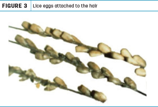 Lice eggs attached to the hair